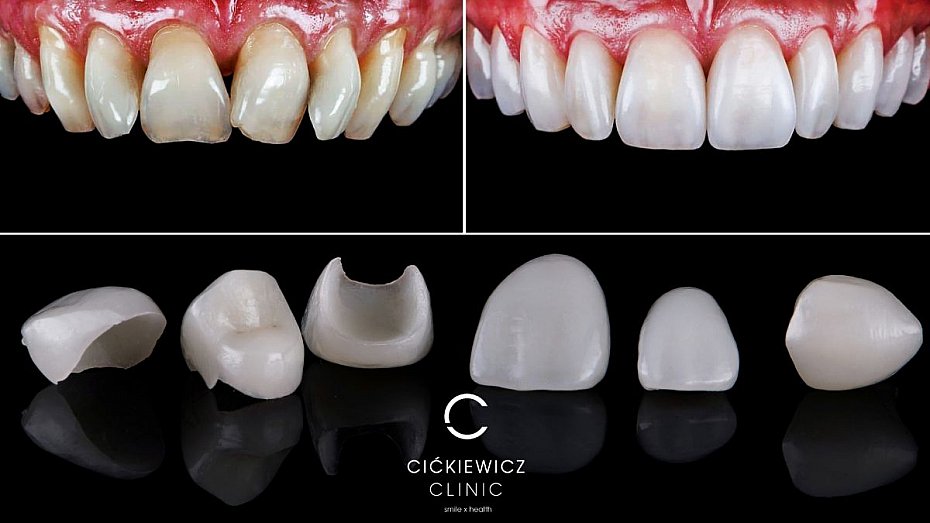 licwki porcelanowe warszawa