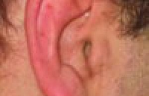 Z zapchanym uchem do lipca