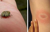 Kleszcze są wszędzie. Jak nie dać się boreliozie?