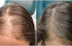 Zatrzymaj wypadanie włosów. Darmowe konsultacje u trychologa