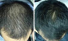 Zatrzymaj wypadanie włosów. Darmowe konsultacje u trychologa