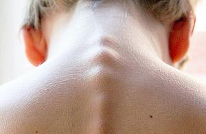 Profilaktyka i leczenie wad postawy. Bezpłatne zajęcia