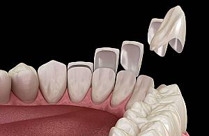 Licówki bez powikłań i ryzyka. Dlaczego renomowany gabinet to podstawa?