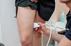 Jak rozpoznać pęknięcie żylaka? Objawy, które powinny zaniepokoić