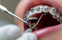 Na czym polega leczenie ortodontyczne? Kiedy warto zdecydowaæ siê na aparat na zêby?