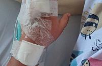Wypadek i szycie rany u dziecka - czy ubezpieczenie NNW mo�e zapewni� odszkodowanie?
